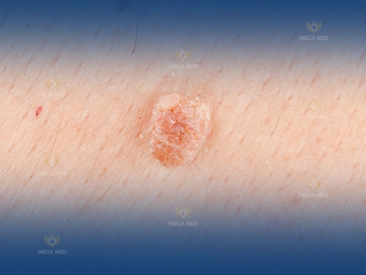 sùi mào gà có tự khỏi không ? 